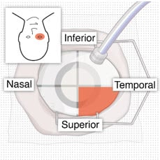 Superotemporal quadrant.image