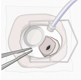 Appearance of the scleral wound after implant removal.image