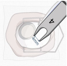 4 mm posterior to the limbus.image