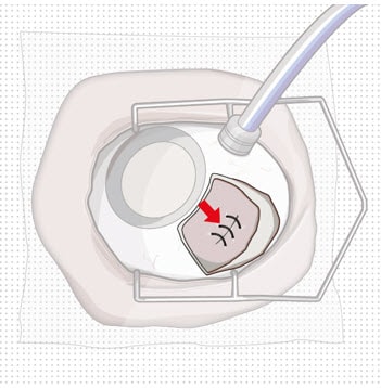 Suture scleral wound using multiple sutures.image