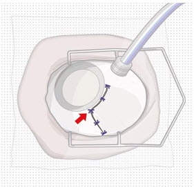 Suture conjunctiva post-removal.image