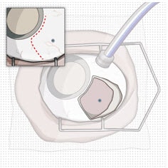 Conjunctival peritomy with blue dot representing selected implant location.image