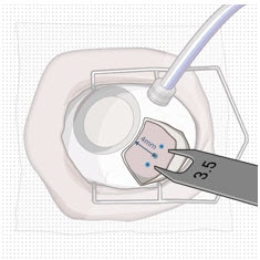 Fixed width caliper measurement.image