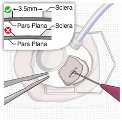 Stabilize the globe and perform full thickness scleral incision.image
