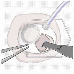 Confirm correct length of scleral incision.image