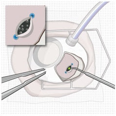 Laser treatment of the pars plana.image