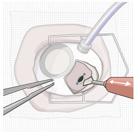 Pars plana incision.image