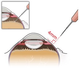 Perpendicular entry of slit knife.image