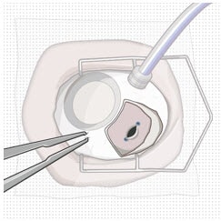 Stabilize the globe with forceps.image