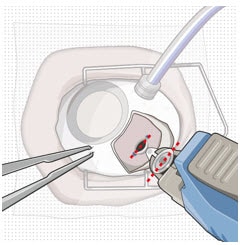 The long axis of the implant aligned with the length of the sclero-pars plana incision.image