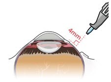 Perpendicular entry of the implant.image