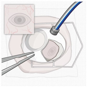 Conjunctival peritomy.image