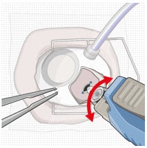 Implant insertion with a slight initial twisting motion.image