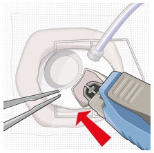 Seat the implant.image