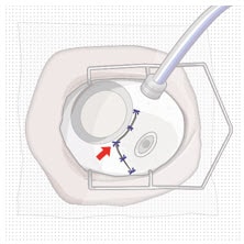 Suture conjunctiva.image