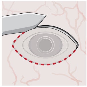 Incision to remove tissue that may be covering the implant flange and septum.image