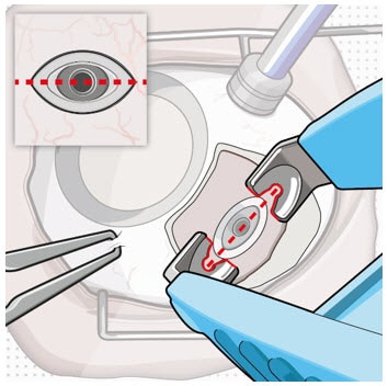 Align the explant tool along the long axis of the implant flange.image