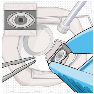 Grasp underneath the long axis of the implant flange.image