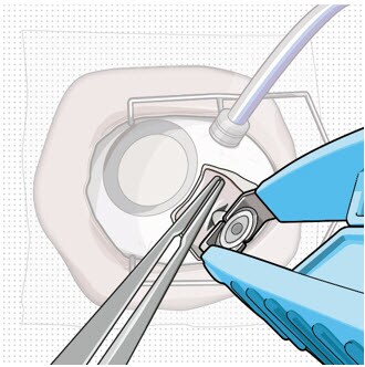 Implant removal.image