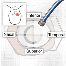 Place infusion cannula in inferotemporal quadrant.image