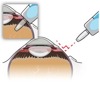 Perpendicular exit of the implant.image