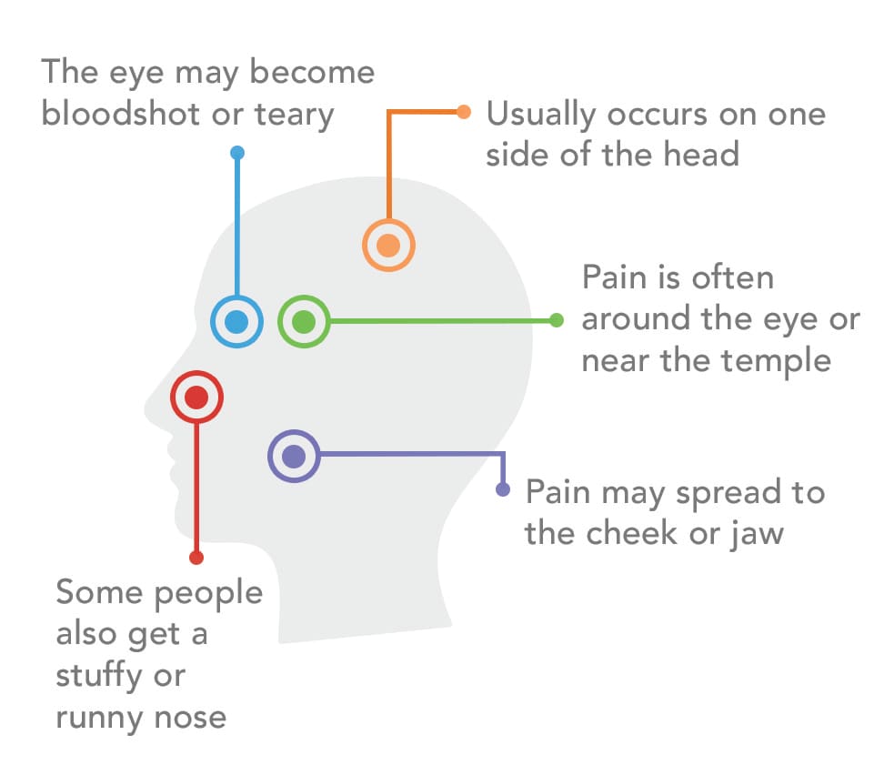 Diagram of a cluster headache