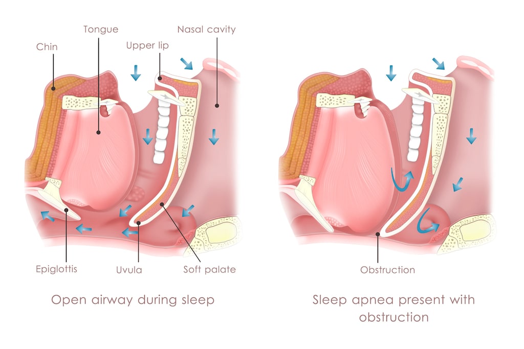 Obstructive sleep apnea - image of obstructed airway.