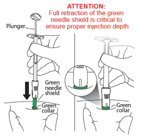 Full retraction of the green needle shield is critical to ensure proper injection depth for the lanreotide injection.