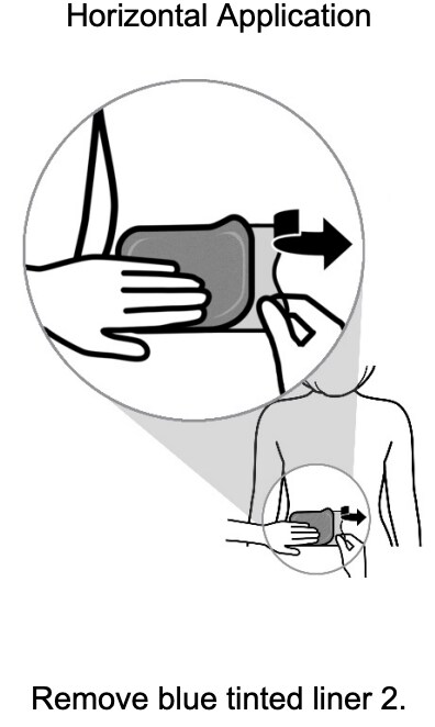 Horizontal application of the Adlarity transdermal system.