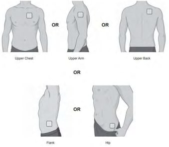 Areas of the body that Xelstrym can be applied to.