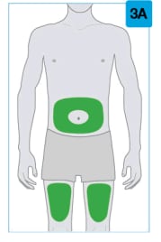 Skyrizi injection sites include front of things and your abdomen at least 2 inches from your belly button.