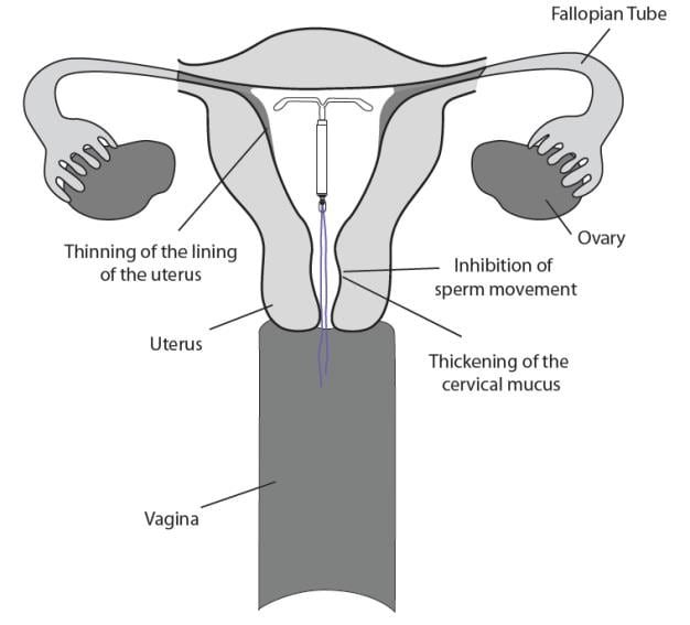 Image of Liletta inserted in the uterus.