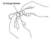 Open the wrapper that contains the 25-gauge needle by peeling apart the tabs and set the needle aside for later use image.