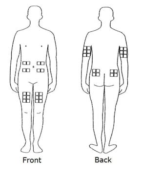 The best sites for giving yourself an injection are those areas with a layer of fat between the skin and muscle, like your thigh, the outer surface of your upper arm, your stomach or buttocks