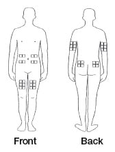 The best sites for giving a subcutaneous injection are those areas with a layer of fat between the skin and muscle. These include the thigh, the outer surface of the upper arm, the stomach and the buttocks. Do not use the area near your waistline or within 2 inches of your navel.