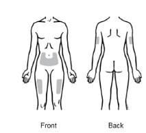 Enbrel injection sites include the front of the middle thighs, the stomach area (except for the 2-inch area right around the navel), and the outer area of the upper arms (only if someone else is giving you the injection) image.