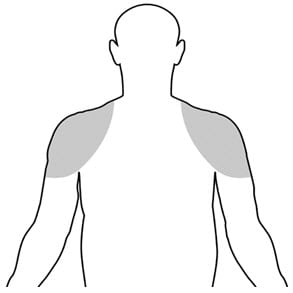 Vogelxo application sites include the shoulder and upper arms.
