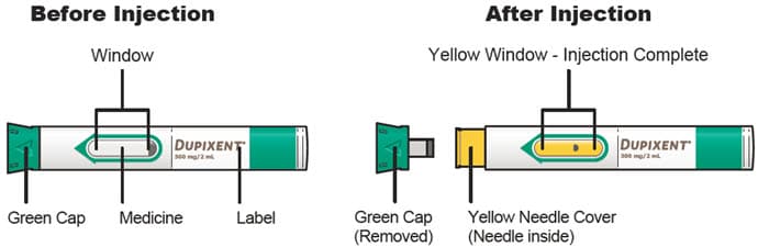 Dupixent pre-filled pen before and after injection with green cap, window showing medicine and label. Green cap is removed for injection revealing yellow needle cover. Window shows yellow when injection complete.
