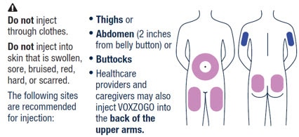 Image of where on the body to inject Voxzogo.