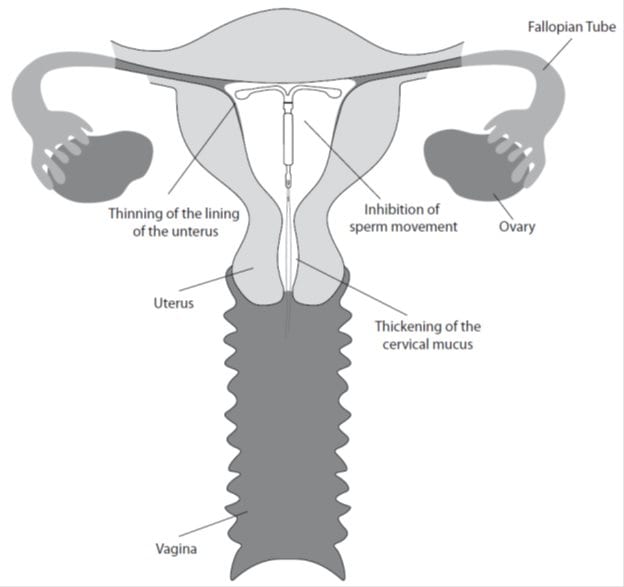 Kyleena may work in several ways including thickening cervical mucus, inhibiting sperm movement, reducing sperm survival, and thinning the lining of your uterus. 