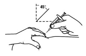 With a quick and “dart-like” motion, insert the needle at a 45-degree angle into the skin image.