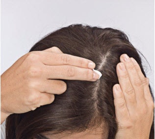 Part your dry hair and apply Sorilux directly to the affected with your fingertips.