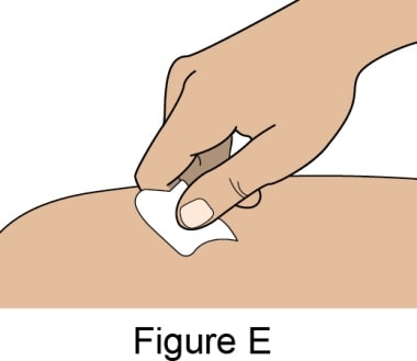 Wipe injection site with alcohol swab.