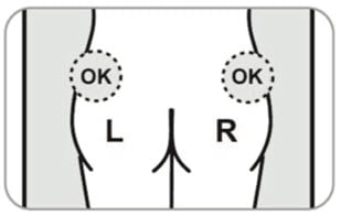 Choose which side of the buttocks to inject Somatuline Depot into. ONLY inject ONE site.