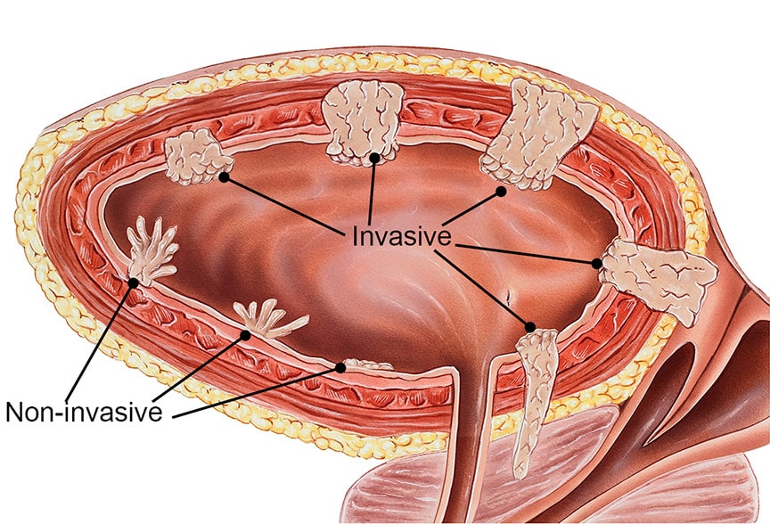 Types of bladder cancer