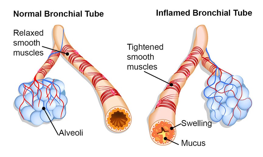 Bronchial