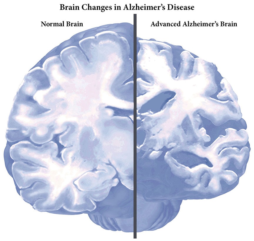 Changes in brain