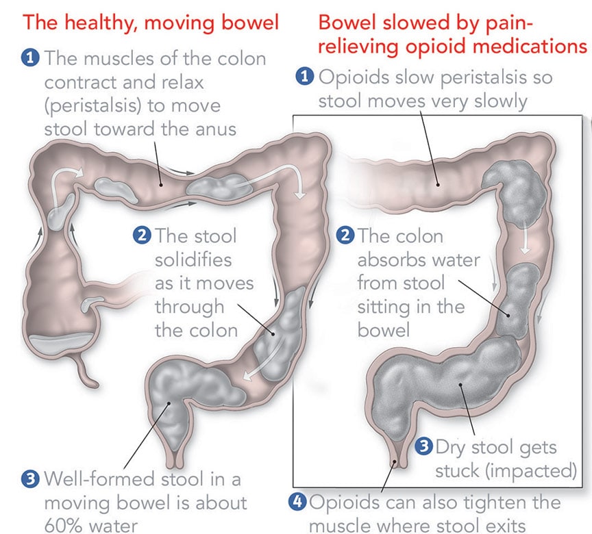 constipation from drugs or suppliments