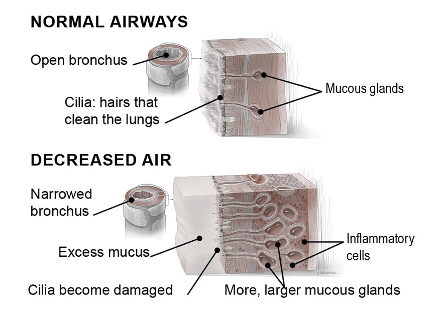 Chronic bronchitis