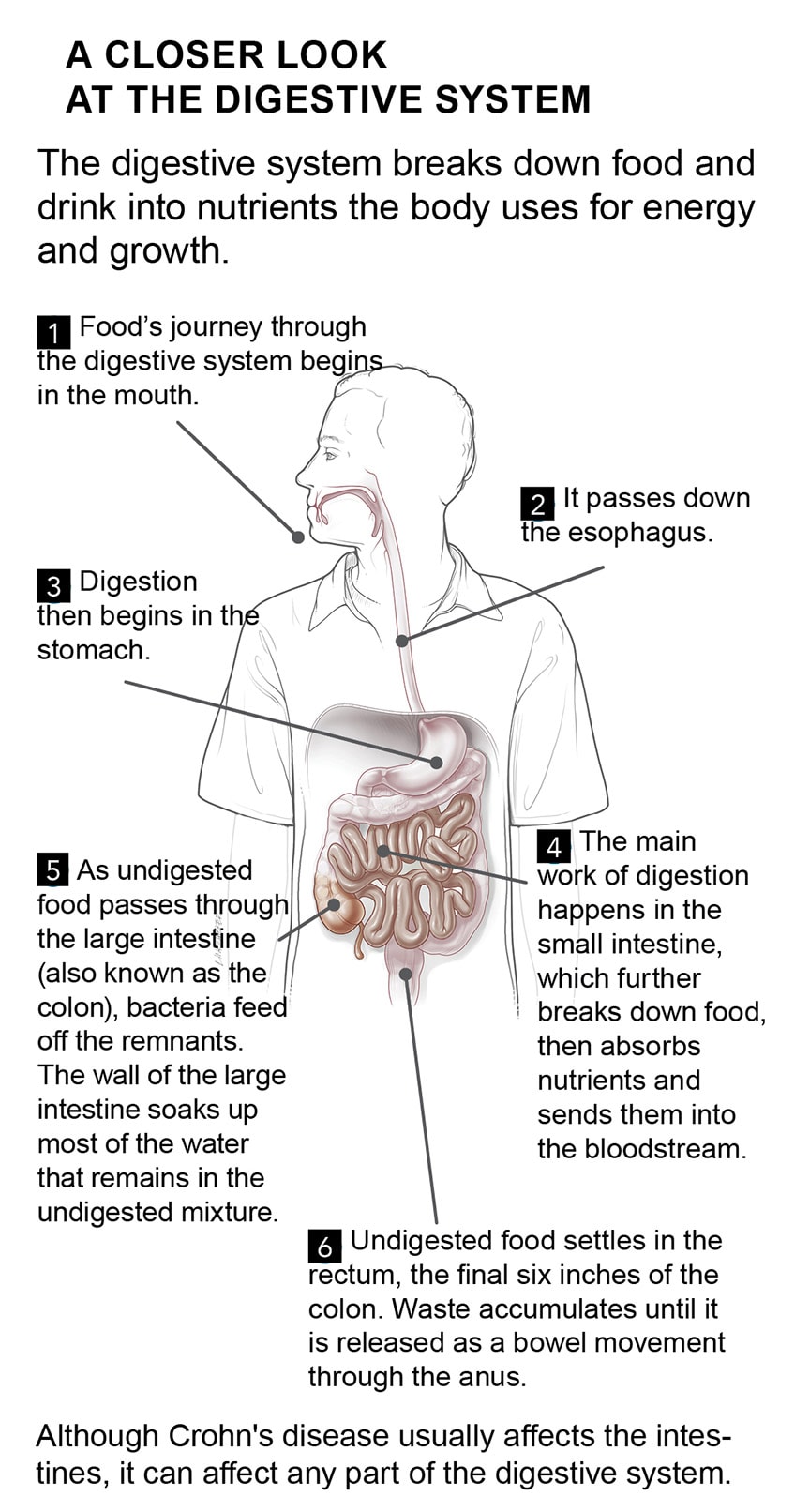 What is crohns disease